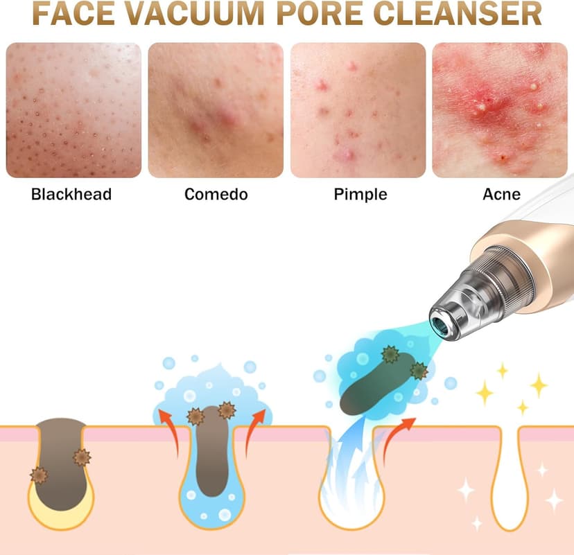 Blackhead Remover Pore Vacuum Kit -Blackhead Extractor Tool with 3 Adjustable Suction Levels, 5 Probes, USB Rechargeable, Suitable for Women and Men(White)